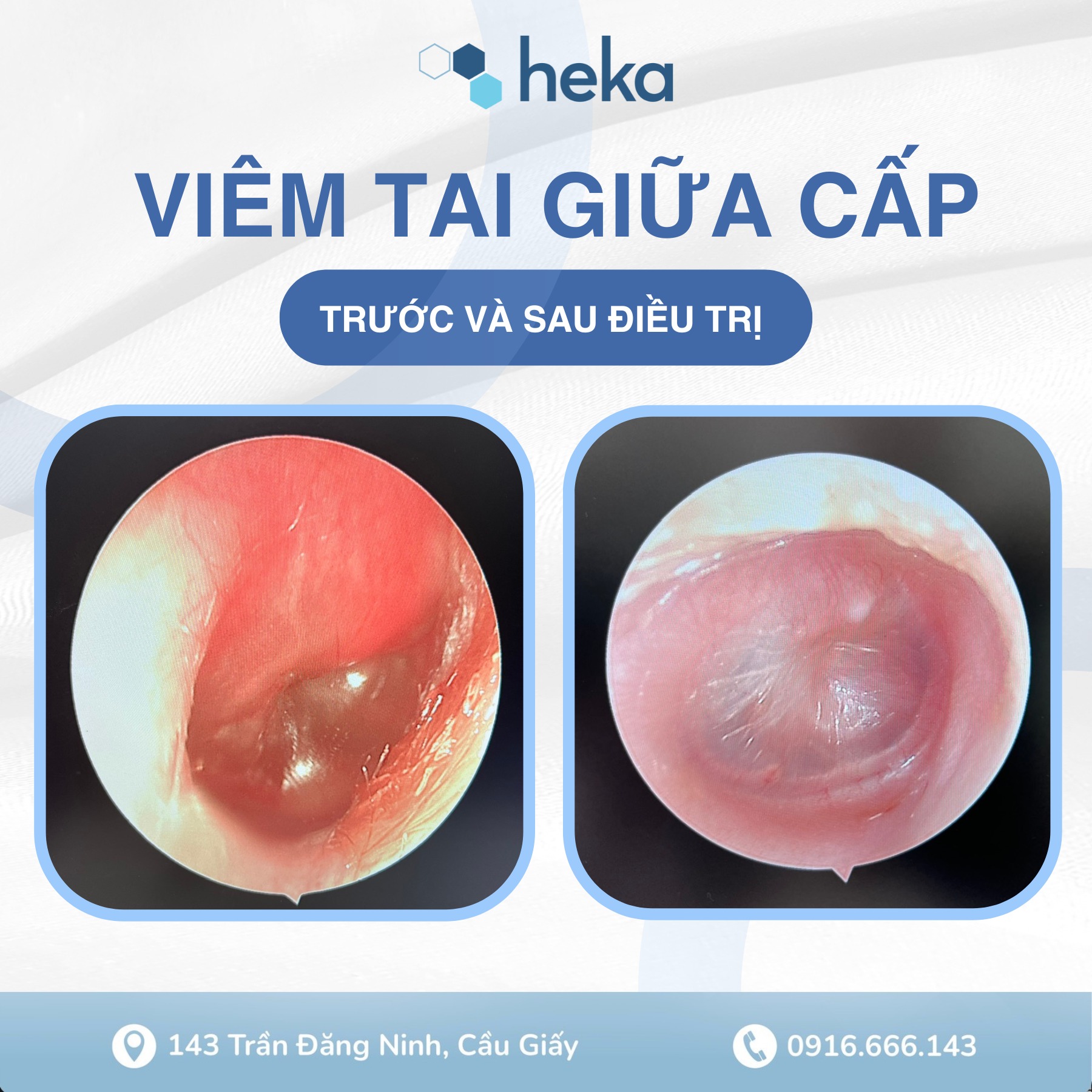 VIÊM TAI GIỮA CÓ CẦN DÙNG KHÁNG SINH KHÔNG? - Phòng Khám Tai Mũi Họng Heka