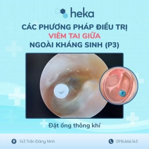 CÁc PhƯƠng PhÁp ĐiỀu TrỊ ViÊm Tai GiỮa KhÁc NgoÀi KhÁng Sinh (p2)