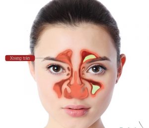 ViÊm Xoang: NguyÊn NhÂn, TriỆu ChỨng VÀ CÁch ĐiỀu TrỊ