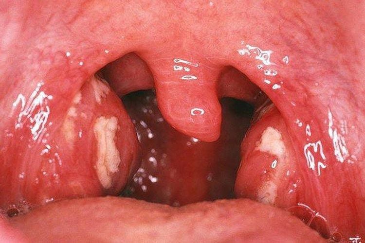 Vì Sao Trẻ Cứ Gặp Lạnh Là Viêm Amidan, Va Lại Tái Phát?