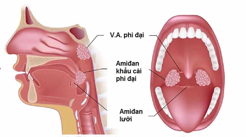 PhẪu ThuẬt Va: Quy TrÌnh, Chi PhÍ VÀ CÁc PhƯƠng PhÁp HiỆn Nay