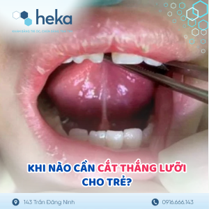 Khi NÀo CẦn CẮt ThẮng LƯỠi Cho TrẺ ?