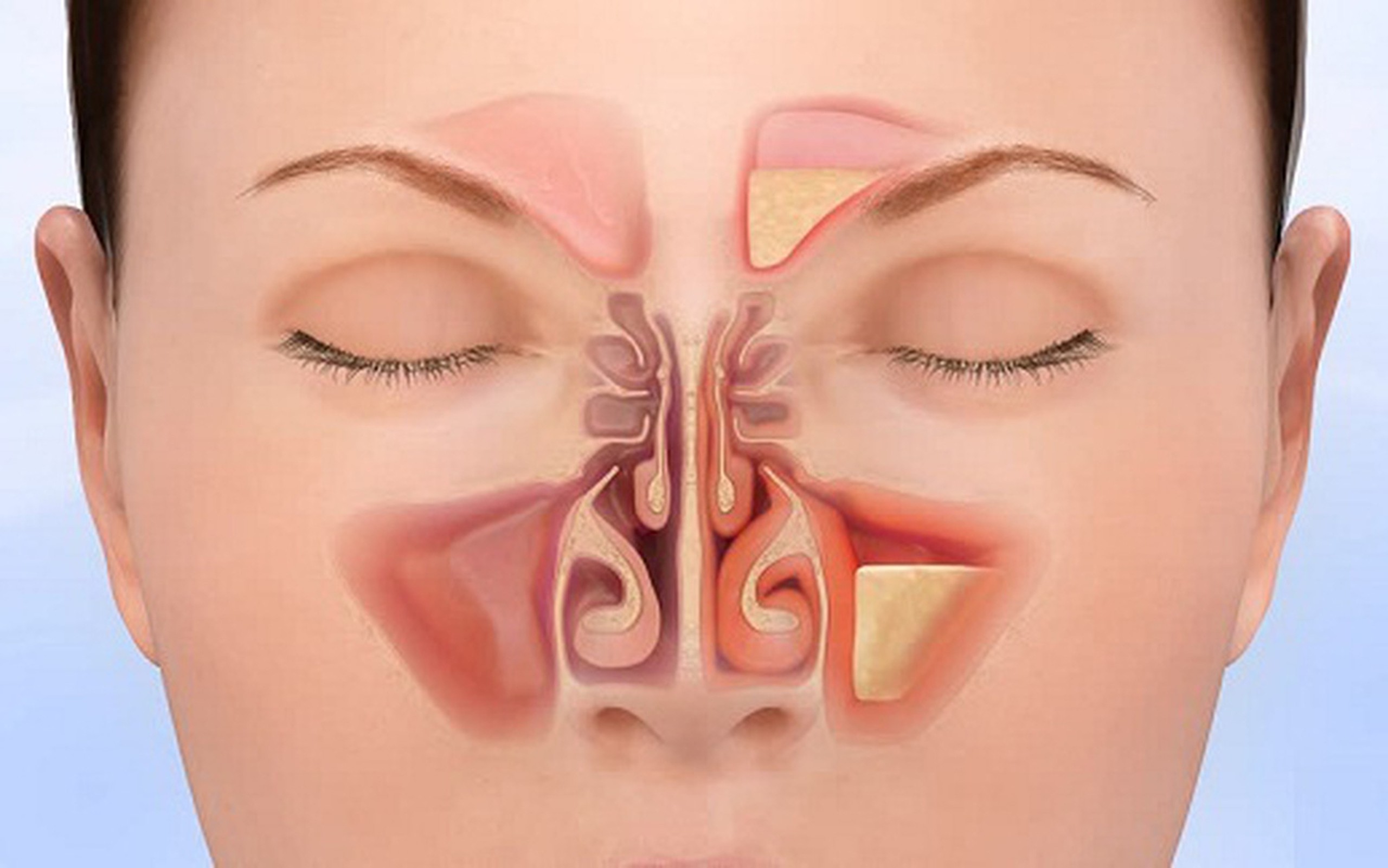 Viêm xoang: Nguyên nhân, triệu chứng và cách điều trị