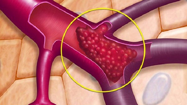 Huyết khối tĩnh mạch xoang hang: Nguyên nhân, triệu chứng, phương pháp phòng và điều trị - Nhà thuốc FPT Long Châu