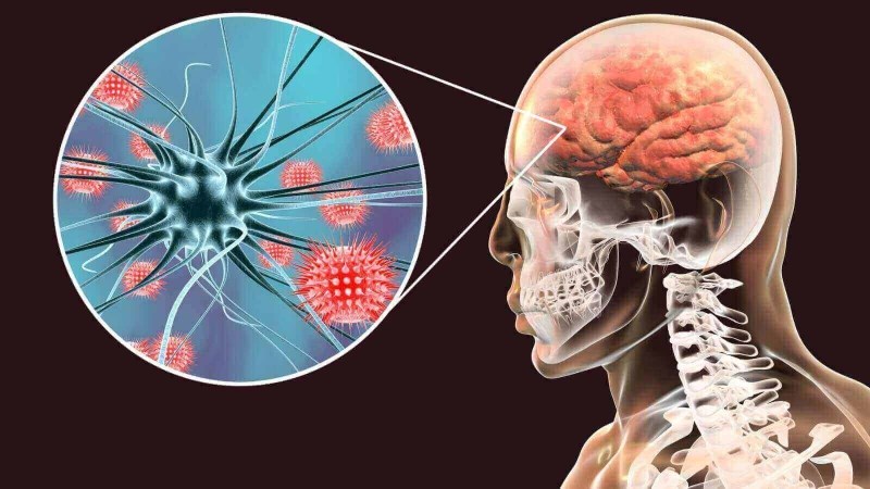 Viêm màng não và các dấu hiệu thường gặp
