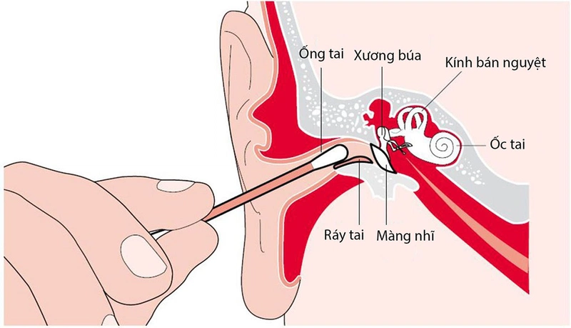Ráy tai là gì, màu sắc ráy tai biểu thị bệnh lý gì? 1