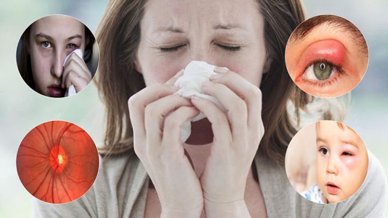 Viêm Xoang Gây Xưng Mắt: Những Biến Chứng, Cách Điều Trị