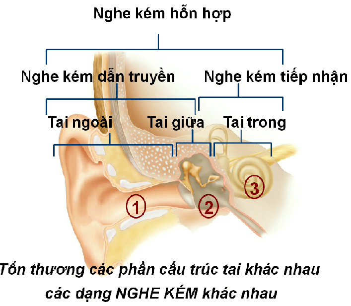 CÁC MỨC ĐỘ NGHE KÉM PHÂN LOẠI VÀ NGUYÊN NHÂN. - Nghe kém