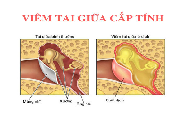 Mẹ đừng bỏ qua triệu chứng viêm tai giữa ở trẻ