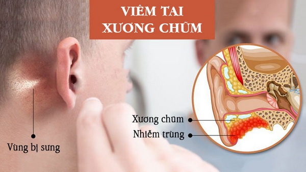 Viêm tai xương chũm