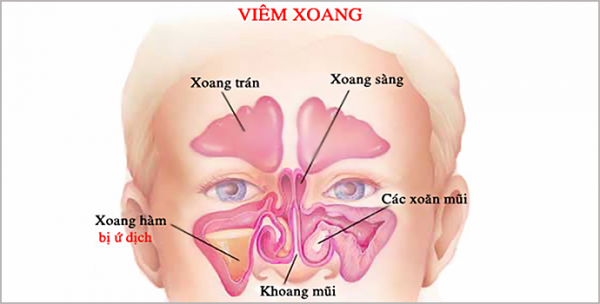 Các loại viêm xoang thường gặp