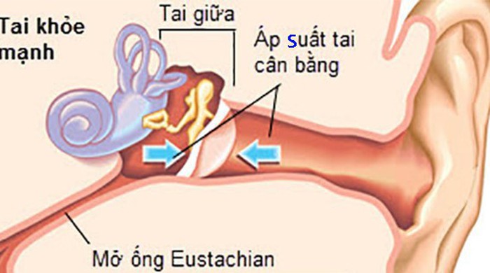 Viêm tai giữa “hàng không” - Tuổi Trẻ Online