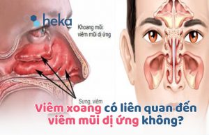 Viêm Xoang Có Liên Quan đến Viêm Mũi Dị ứng Không?
