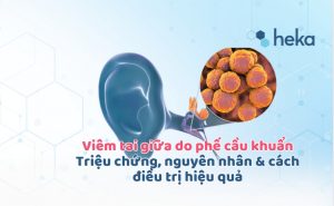 Viêm Tai Giữa Do Phế Cầu Khuẩn: Triệu Chứng, Nguyên Nhân & Cách điều Trị Hiệu Quả