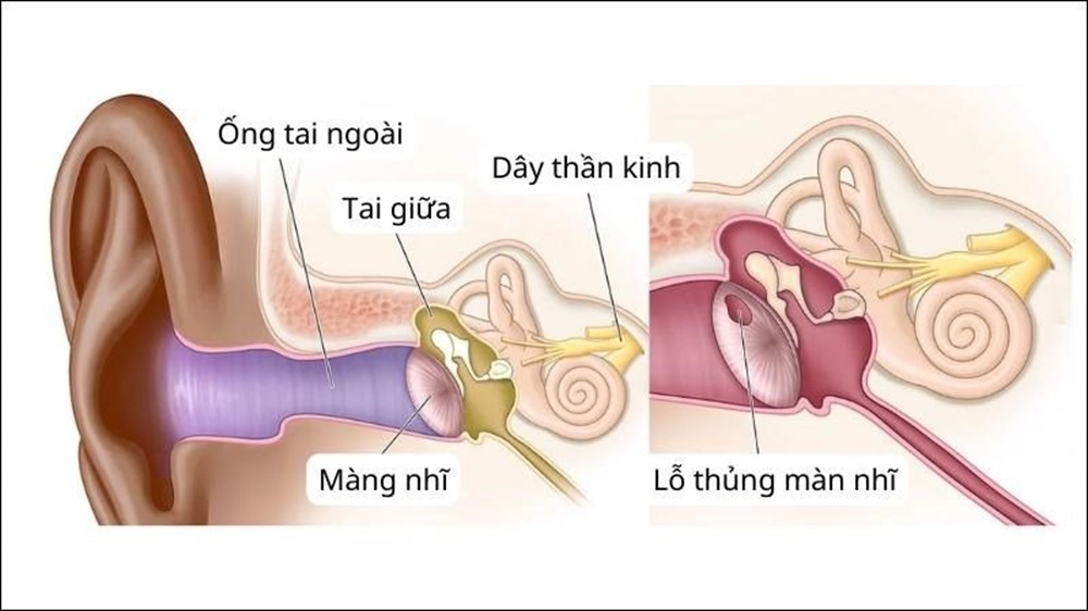Thủng màng nhĩ - Nguyên nhân - Triệu chứng và cách phòng ngừa - Hội thính học Việt Nam - Viet Nam Audiology Asscociation