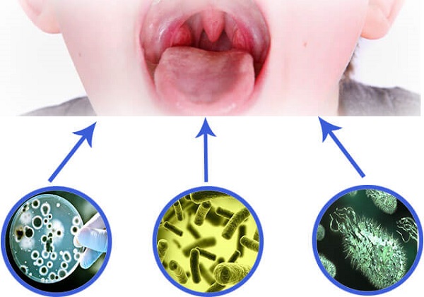 Nguyên nhân và cách chăm sóc đúng cách khi trẻ bị viêm mũi họng cấp khi thời giao mùa