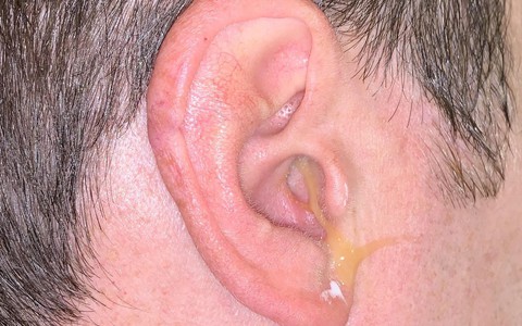 Viêm tai giữa ở người lớn biểu hiện thế nào?