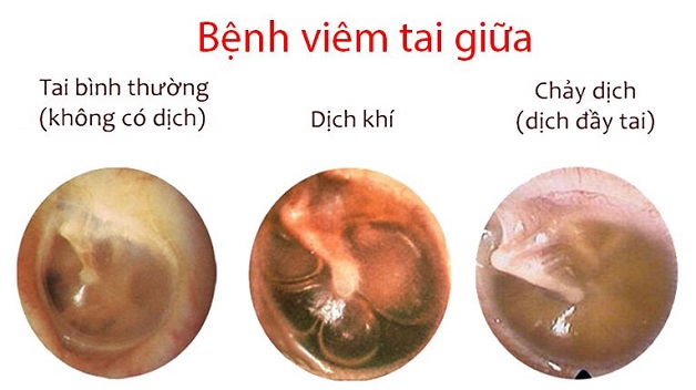 Viêm tai giữa trẻ sơ sinh: những điều cần biết | BvNTP