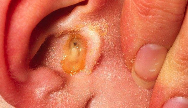 Viêm tai giữa ứ dịch: Nguyên nhân, triệu chứng và cách điều trị – BẢO ĐẠI ĐƯỜNG
