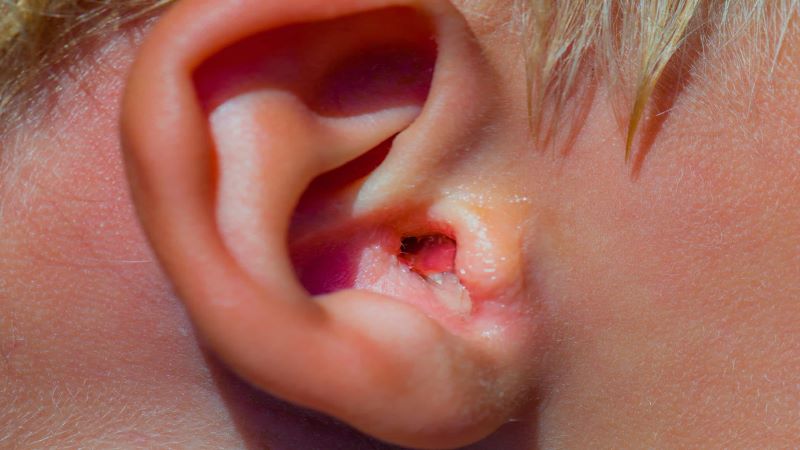 Biểu hiện viêm tai ngoài, viêm tai ngoài có tự khỏi