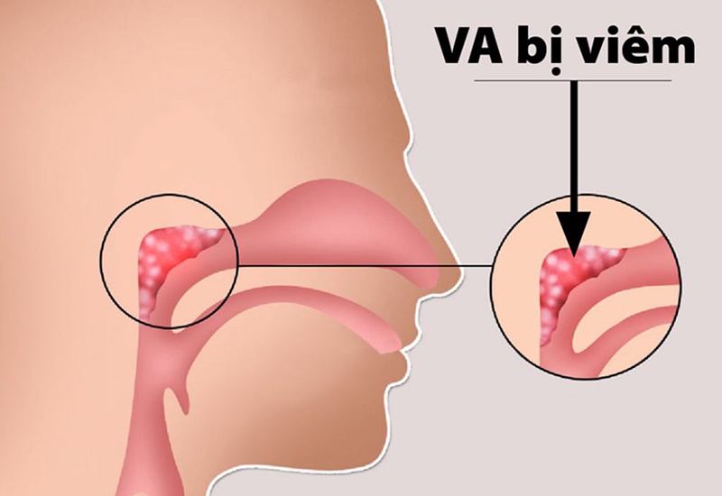 Viêm VA là gì? Cách điều trị bệnh như thế nào?
