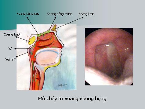Hội chứng chảy dịch mũi sau (Postnasal Drips)