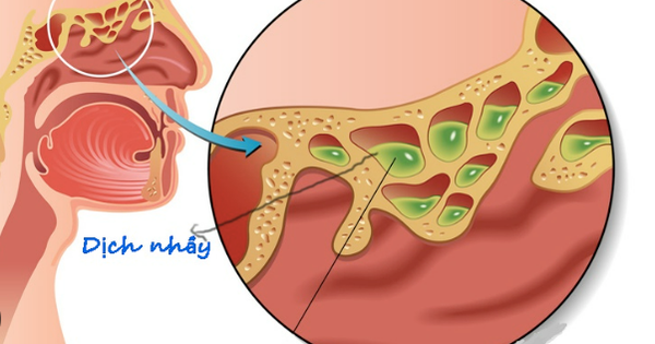 6 biện pháp tự nhiên điều trị nghẹt mũi