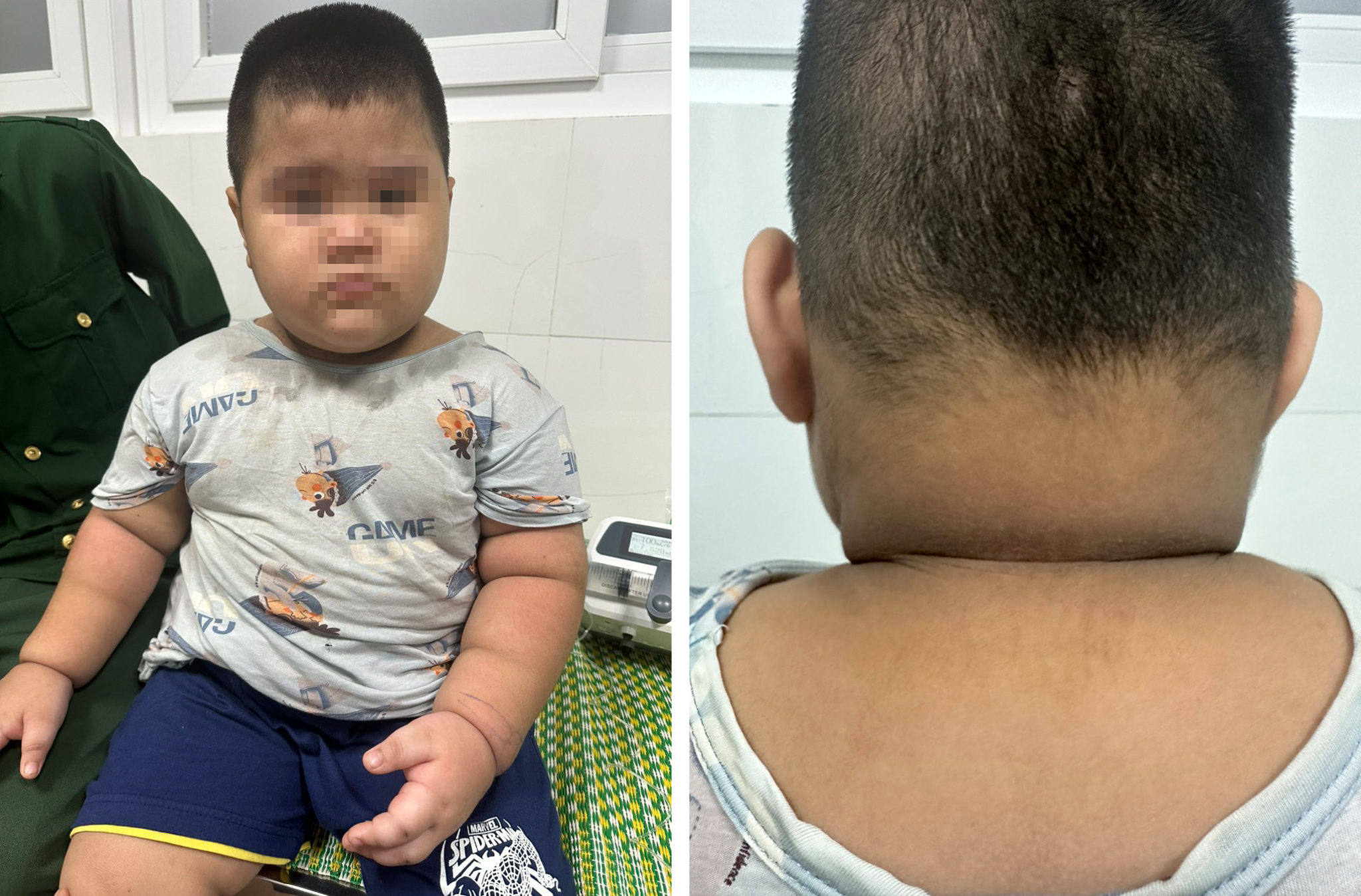 Điều trị hội chứng Cushing ở trẻ em | Khoa học thường thức