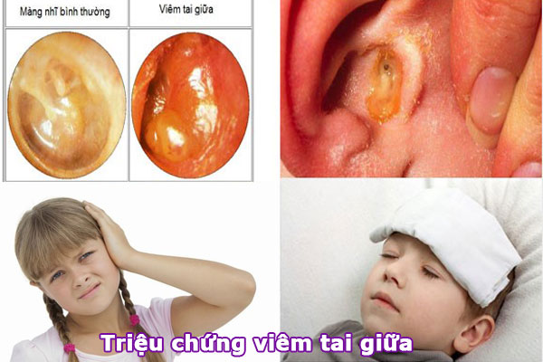 NGUYÊN NHÂN VÀ BIỂU HIỆN THƯỜNG GẶP CỦA TRẺ KHI BỊ VIÊM TAI GIỮA. - Viên Minh Đường