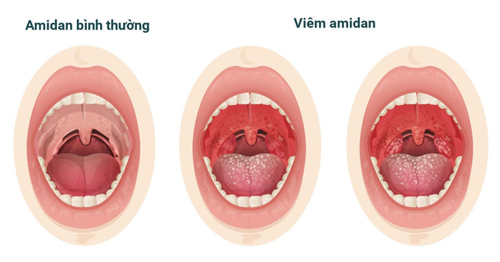 Viêm amidan cấp tính ở trẻ em: nguyên nhân, triệu chứng và điều trị