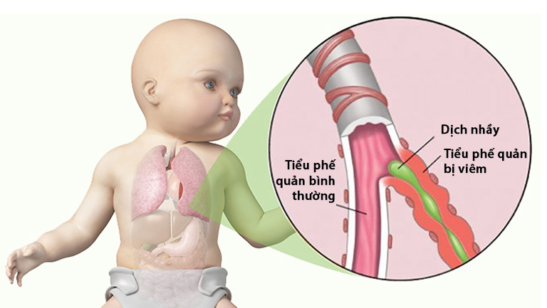 Trẻ viêm tiểu phế quản có nên dùng thuốc kháng sinh?