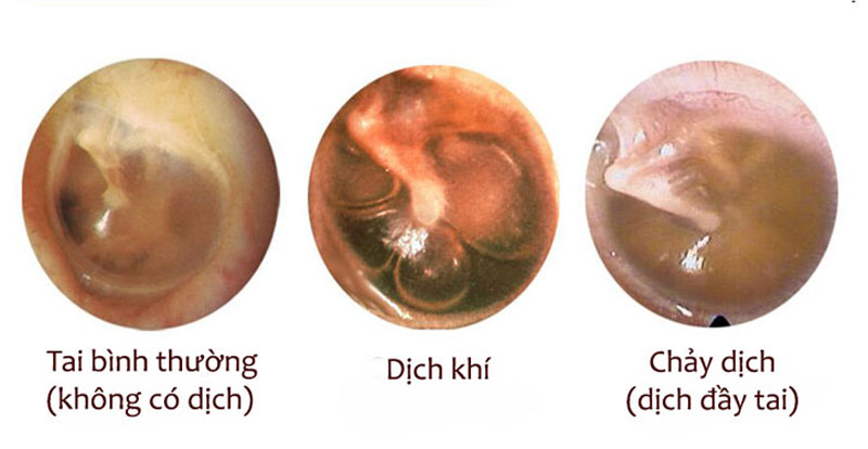 Giải đáp băn khoăn: Viêm tai giữa ứ dịch có tự khỏi không