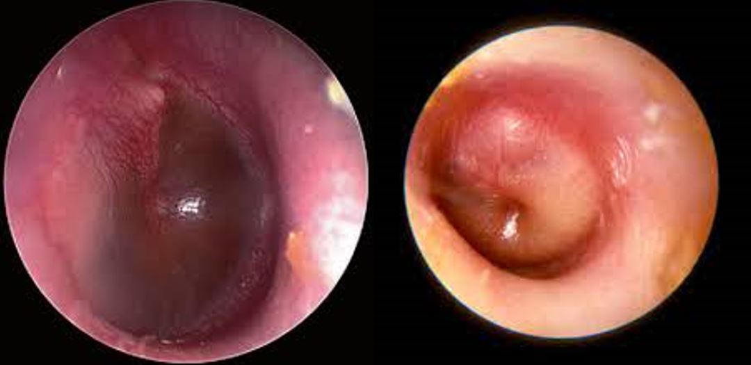 Viêm tai giữa cấp tính ở trẻ (Acute Otitis Media)