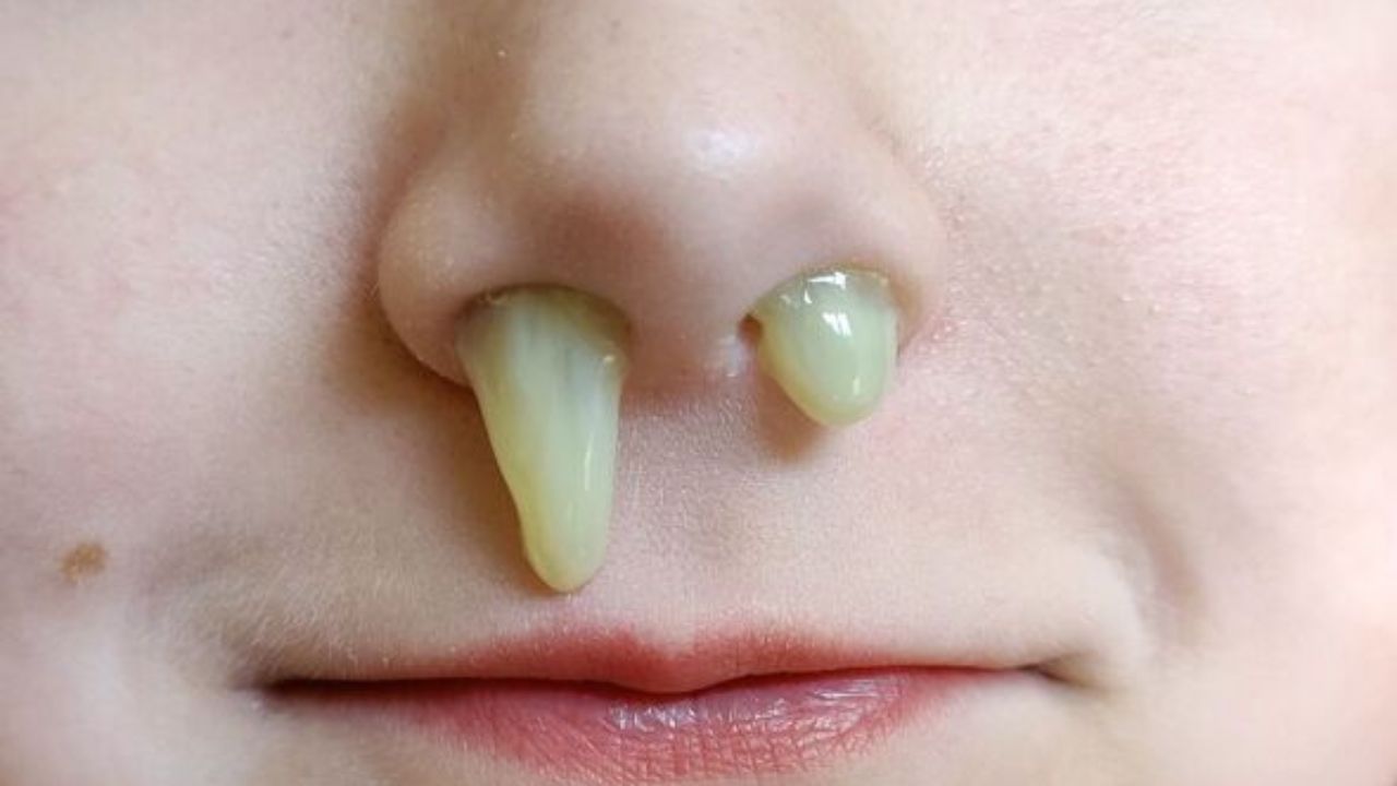 Dịch mũi màu xanh là biểu hiện của bệnh lý gì? Khi nào phải đi khám?