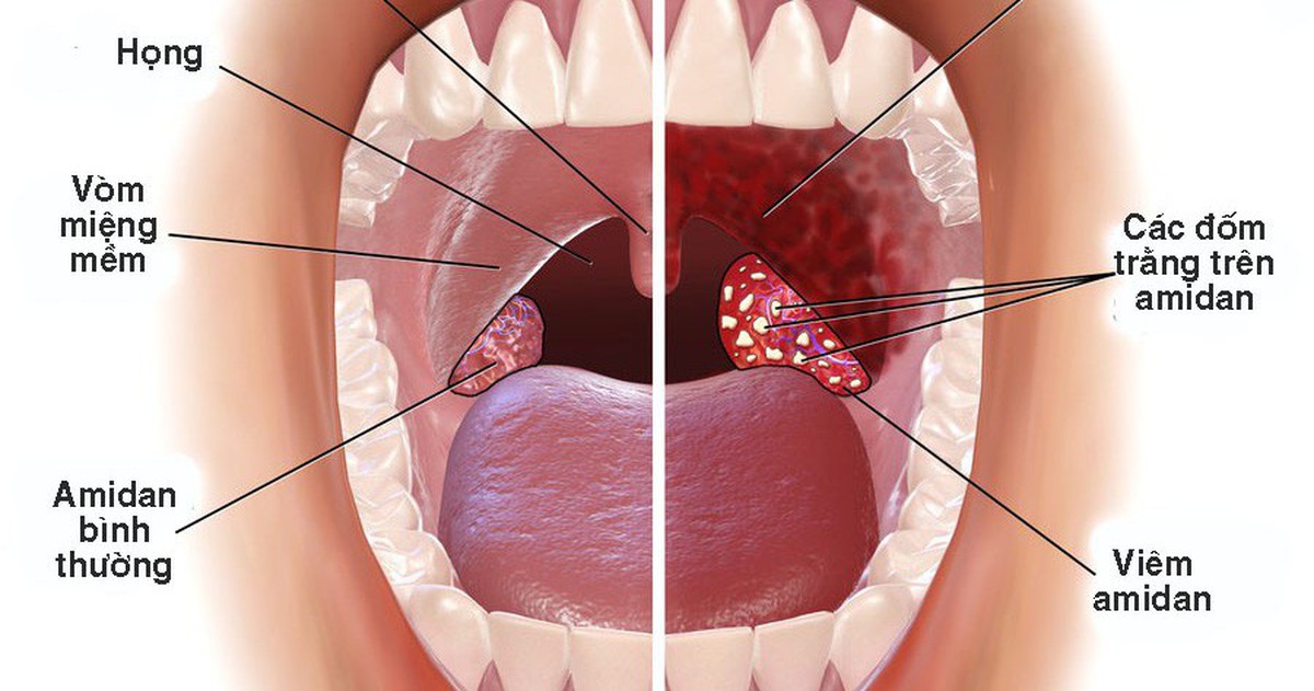 Mùa hè, viêm họng nhiều cơ hội tái phát - Tuổi Trẻ Online