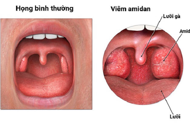 Trẻ bị viêm amidan cấp cần lưu ý gì khi giao mùa?
