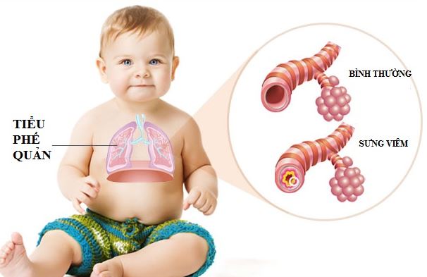 Viêm tiểu phế quản cấp ở trẻ khi thời tiết giao mùa