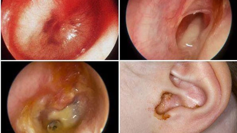 Viêm tai giữa mạn tính thủng nhĩ có nguy hiểm không? - Nhà thuốc FPT Long Châu