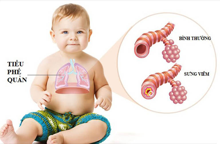 Viêm tiểu phế quản ở trẻ: Nguyên nhân, dấu hiệu và điều trị