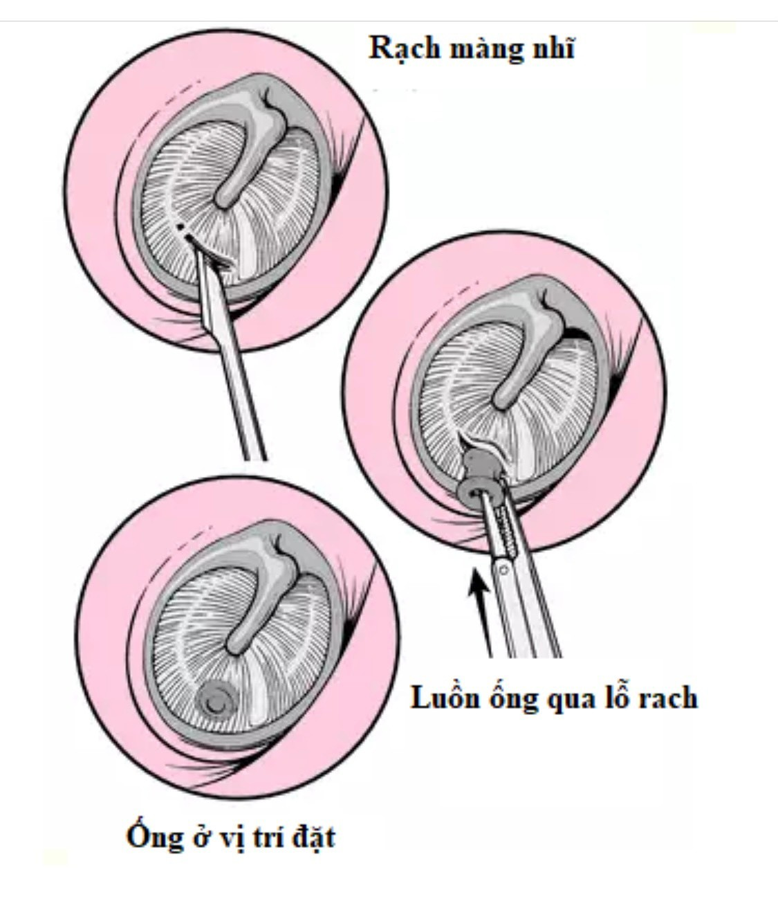 Đặt Otk Hay Chích Nhĩ Có Giúp Khỏi Viêm Tai Giữa Nhanh Hơn Không?