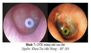 Lạm Dụng đặt Otk, Chích Nhĩ – Có Nguy Cơ Gì