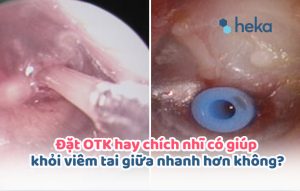 Đặt Otk Hay Chích Nhĩ Có Giúp Khỏi Viêm Tai Giữa Nhanh Hơn Không?