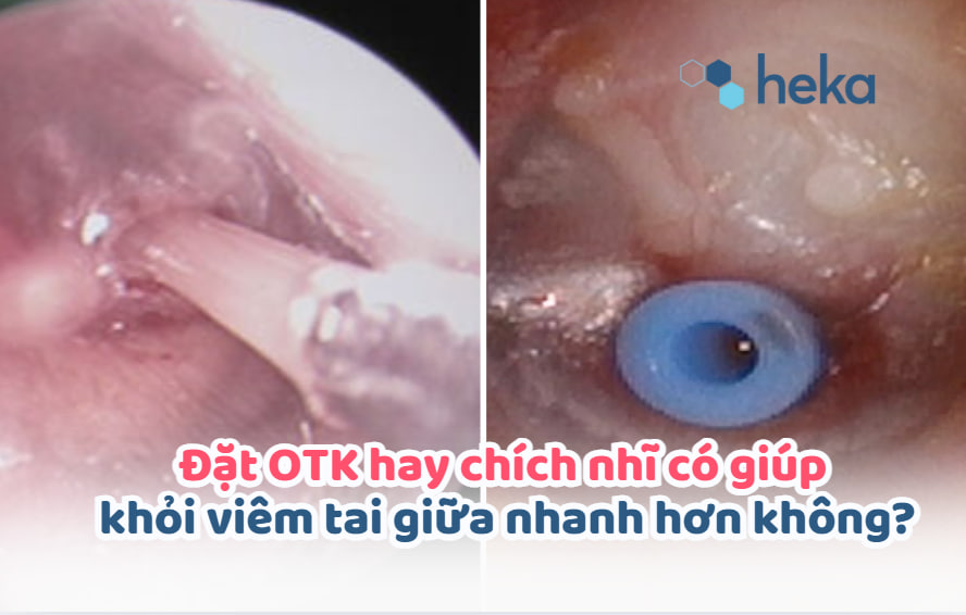 Đặt Otk Hay Chích Nhĩ Có Giúp Khỏi Viêm Tai Giữa Nhanh Hơn Không?