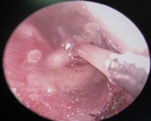 Lạm Dụng đặt Otk, Chích Nhĩ – Có Nguy Cơ Gì