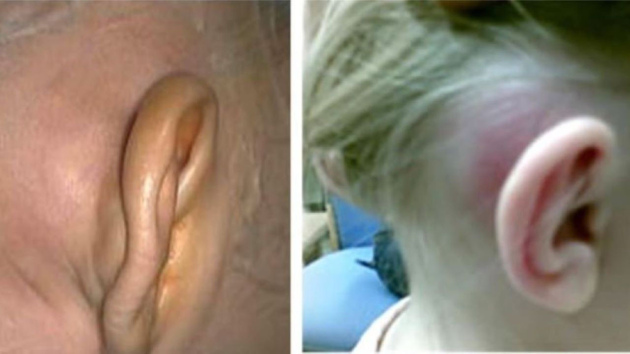 Nếu Con Bạn đang Bị Viêm Tai Giữa, đừng Hoang Mang!