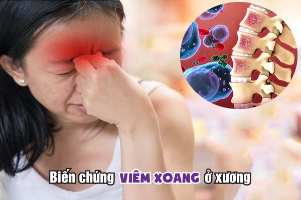 Những Biến Chứng Nguy Hiểm Của Viêm Xoang Không điều Trị