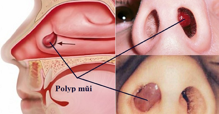 Điều trị polyp mũi tại nhà có tốt không? Các cách điều trị polyp mũi hiệu quả nhất – Bệnh Viện An Việt