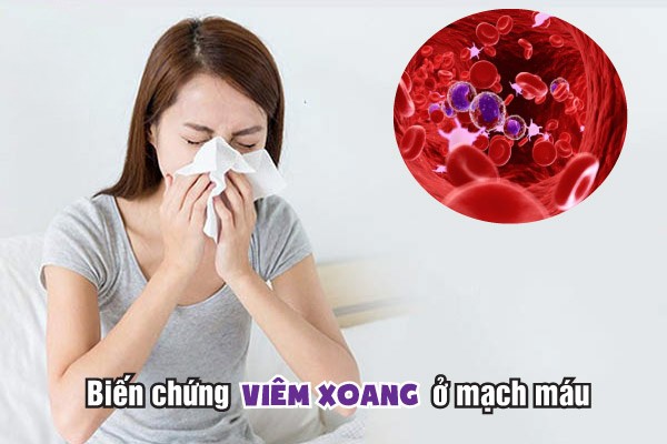 Những Biến Chứng Nguy Hiểm Của Viêm Xoang Không điều Trị