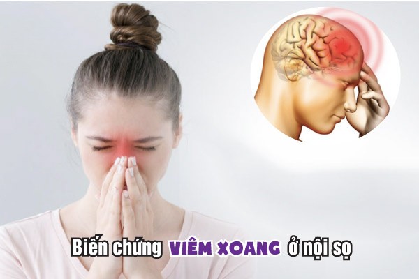 Những Biến Chứng Nguy Hiểm Của Viêm Xoang Không điều Trị