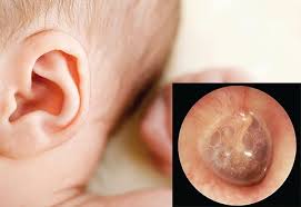 Vai Trò Của Adenoid (va) Trong Viêm Xoang Trẻ Em